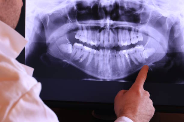 Best Emergency Wisdom Tooth Extraction in Linden, NJ